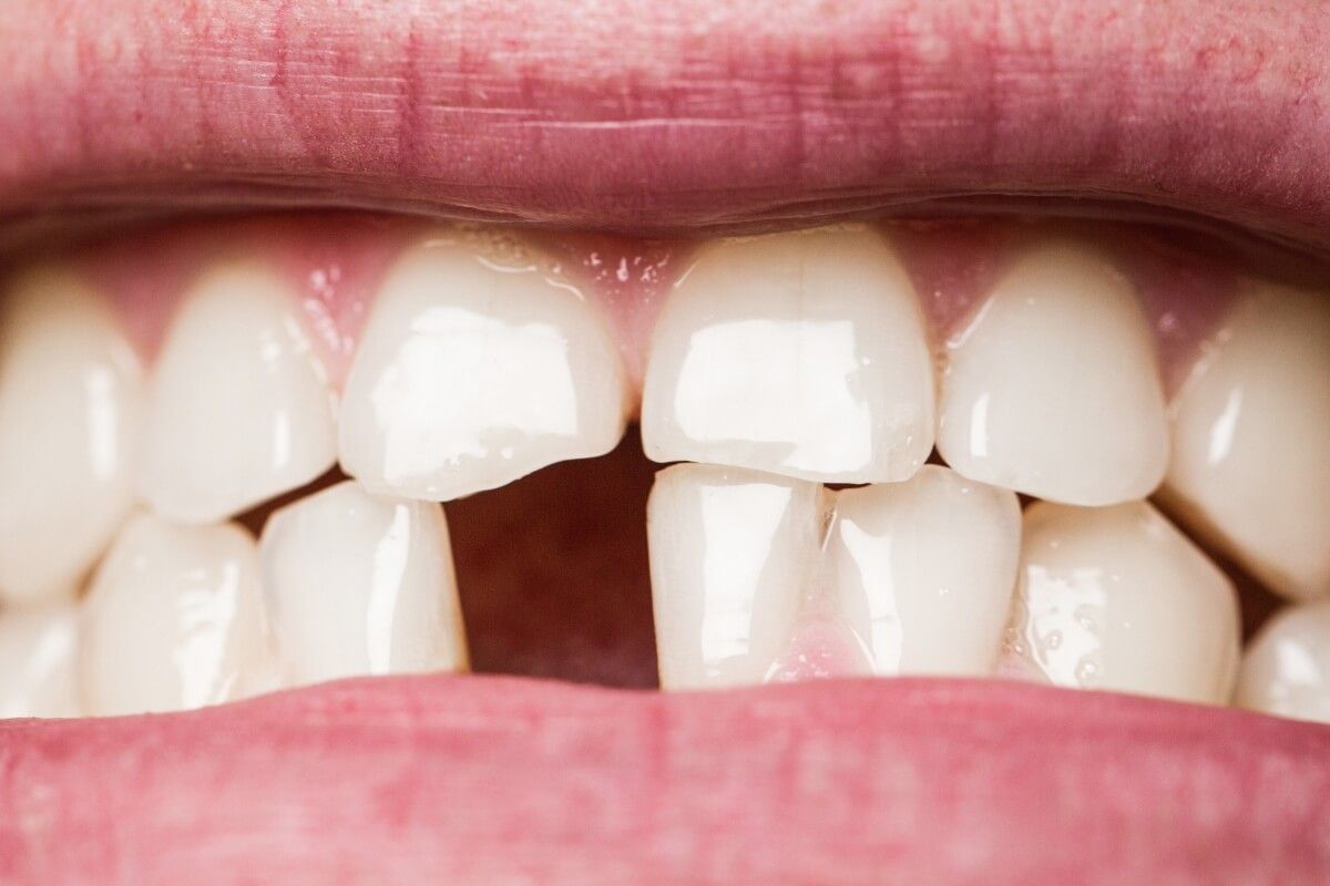 Falta de dientes