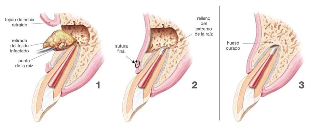 Imagen del procedimiento quirúrgico: Detalle de cómo la apicectomía elimina infecciones en la raíz del diente, preservando su funcionalidad.