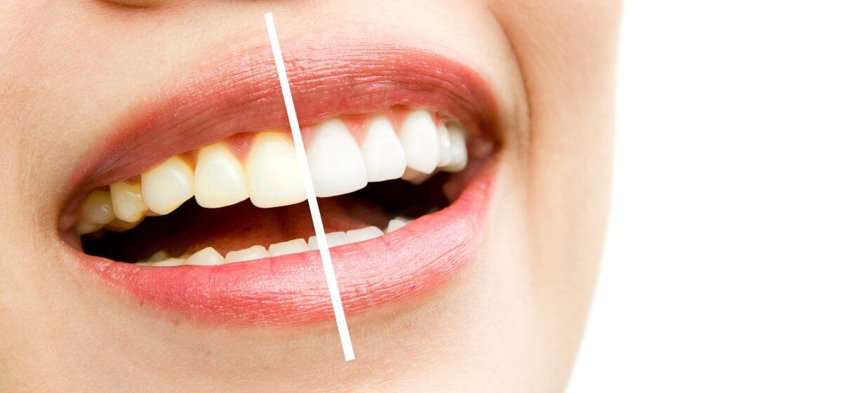 Clínica Maxilofacial Calvo de Mora, Madrid, estética dental, blanqueamiento de dientes, tratamiento de blanqueamiento dental,