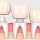 colocación coronas dentales en mejor clinica maxilofacial madrid. Clínica dental para implantes dentales mejor calidad.
