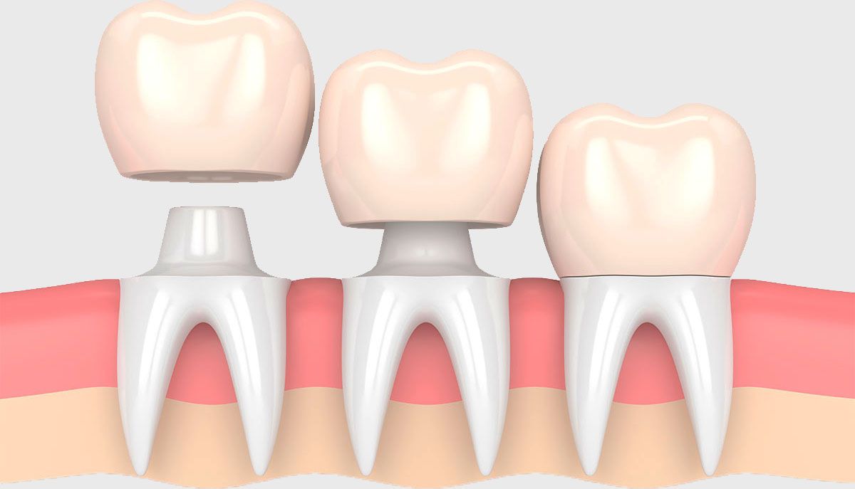 colocación coronas dentales en mejor clinica maxilofacial madrid. Clínica dental para implantes dentales mejor calidad.