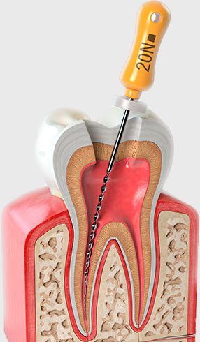 Endodoncia en clínica dental privada Madrid, tratamiento dental, odontología, clínica Maxilofacial, clínica premium