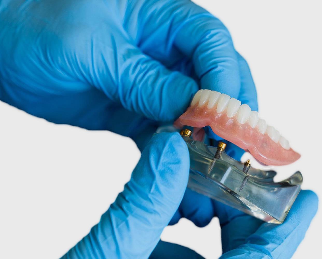 prótesis sobre implantes, Prótesis dentales, Clínica dental Madrid, Clínica Maxilofacial Madrid, sobredentadura sobre 2 implantes precio