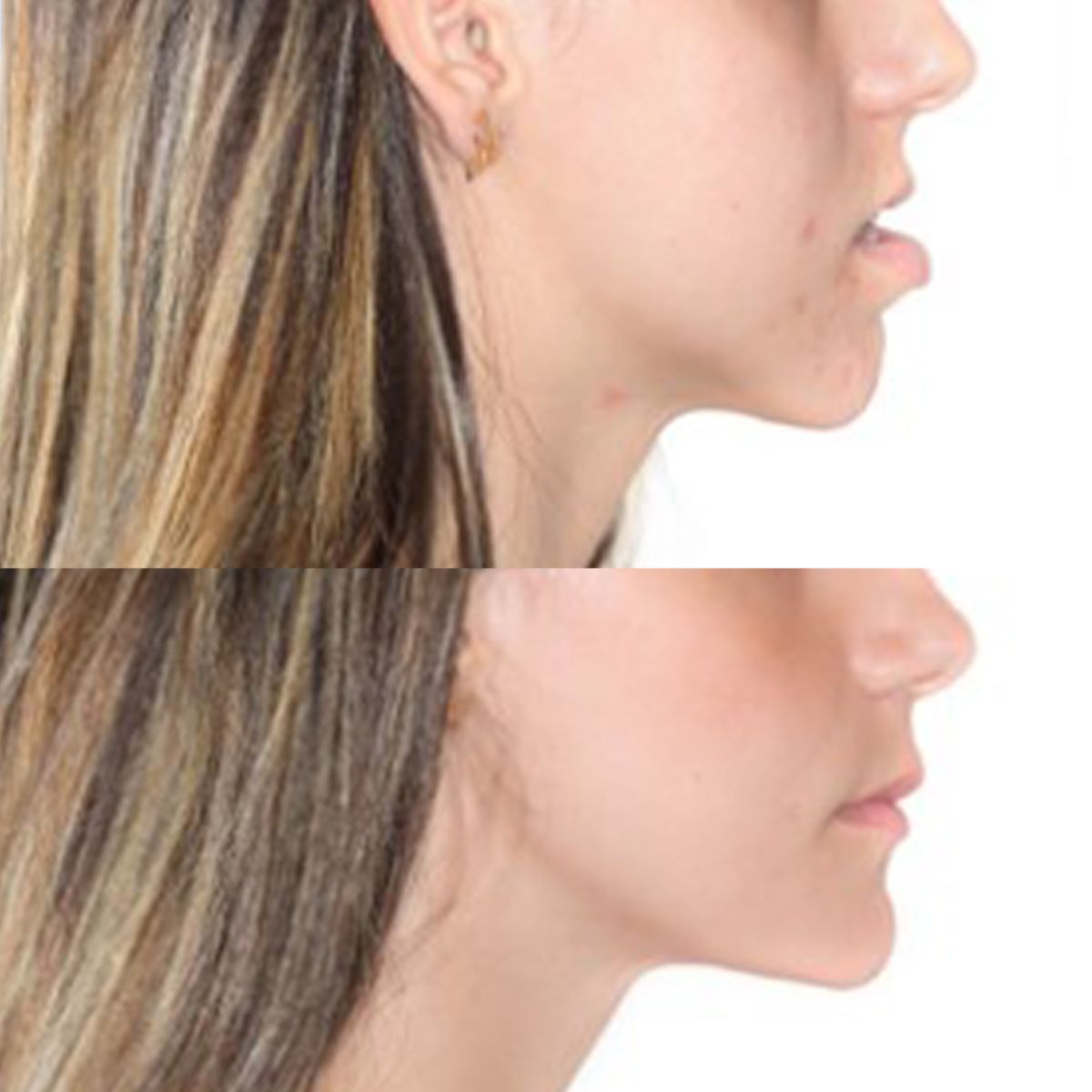 Tratamiento de cirugía ortognática en clínica maxilofacial calvo de mora en madrid