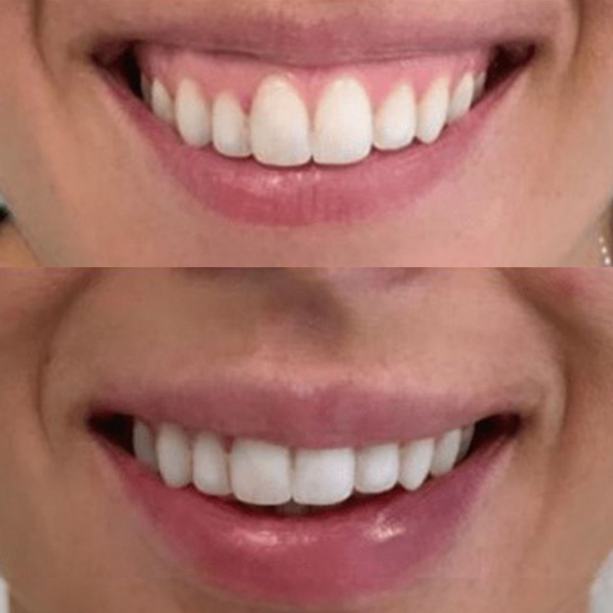 Tratamiento sonrisa gingival con cirugía ortognática en clínica maxilofacial Madrid