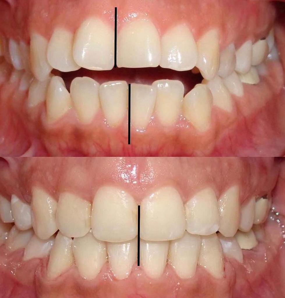 Antes y después de mordida abierta, tratamiento de ortodoncia y cirugía ortognática en mejor clínica maxilofacial calvo de mora madrid