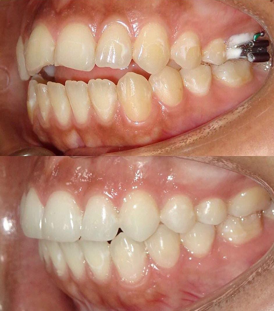 Mejor clinica maxilofacial de españa, clinica calvo de mora, corrección mordida abierta con cirugía ortognática