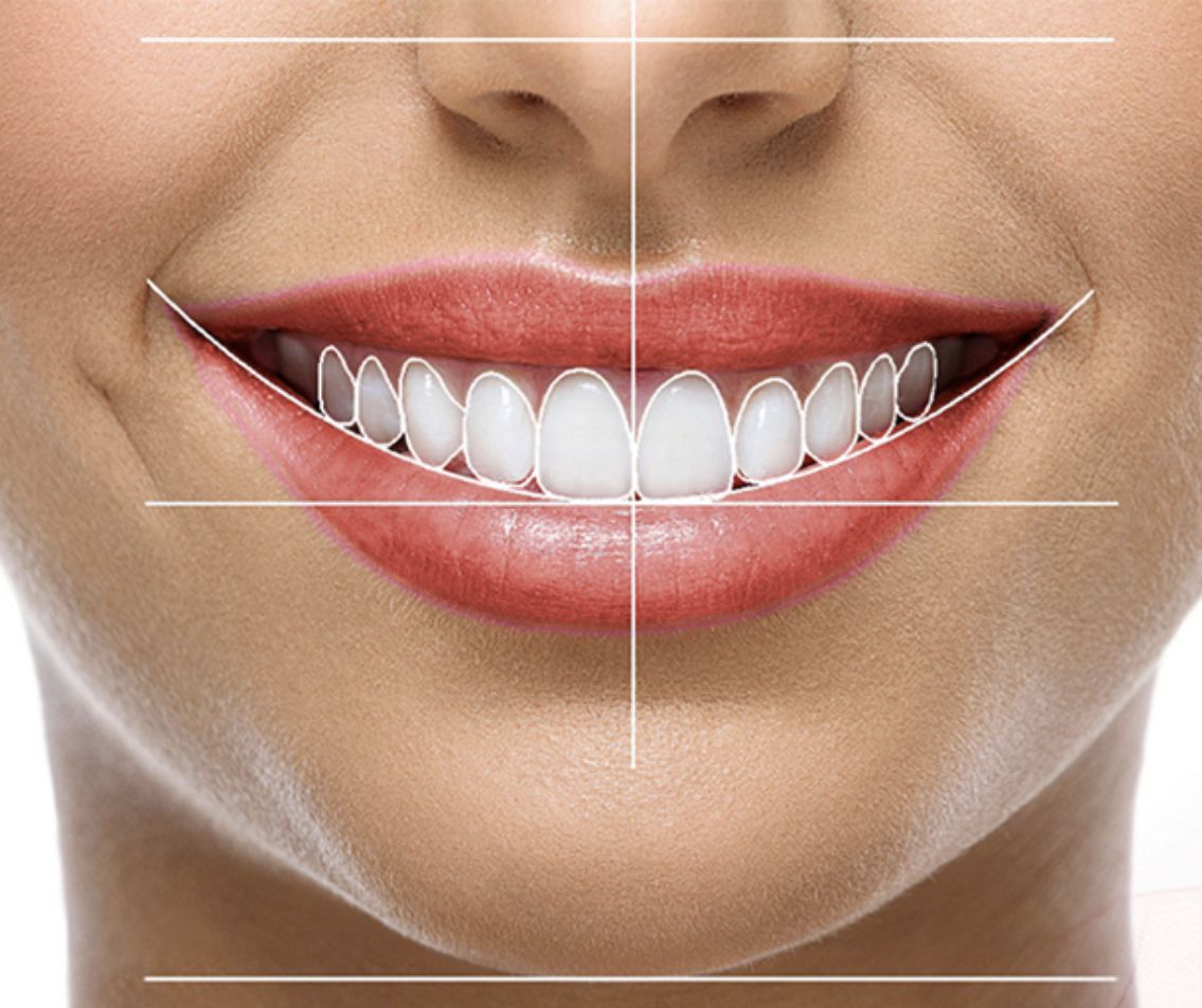 Diseño de sonrisa digital en madrid, mejor clínica maxilofacial calvo de mora, clinica dental, carillas