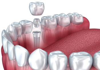 Los mejores implantes dentales en Clínica Maxilofacial Calvo de Mora en Madrid