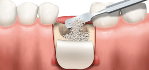 injerto óseo dental en clinica maxilofacial calvo de mora de madrid mejores implantes dentales calidad precio