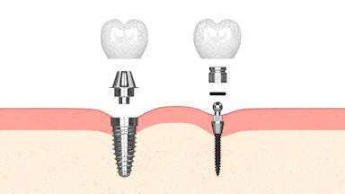 tipos de implantes dentales de alta calidad en clinica maxilofacial calvo de mora de madrid. tratamientos de lujo