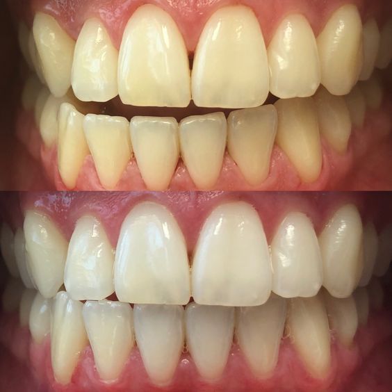 antes y después de un blanqueamiento dental profesional con luz led. tratamiento blanqueamiento dental