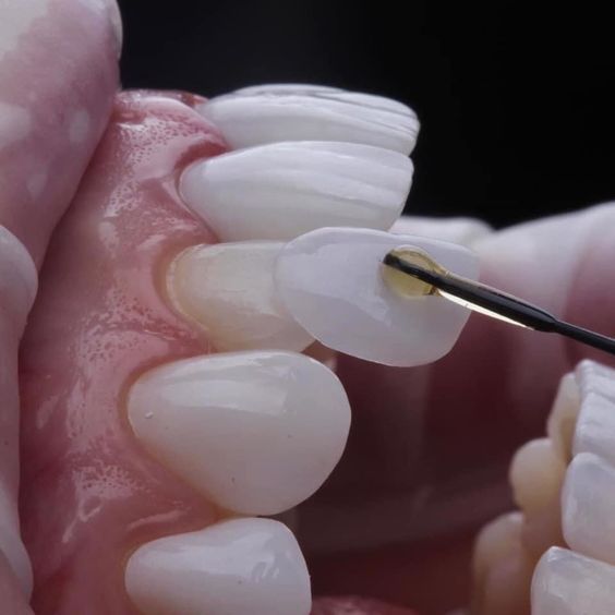 Tratamiento estética dental carillas de composite y porcelana. Diseño sonrisa en mejor clínica dental de Madrid. colocación carillas de lujo