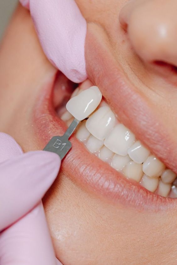 colocación carillas dentales composite, porcelana, diseño de sonrisa digital en mejor clínica dental, Carillas de lujo clínica Madrid, carillas alta calidad