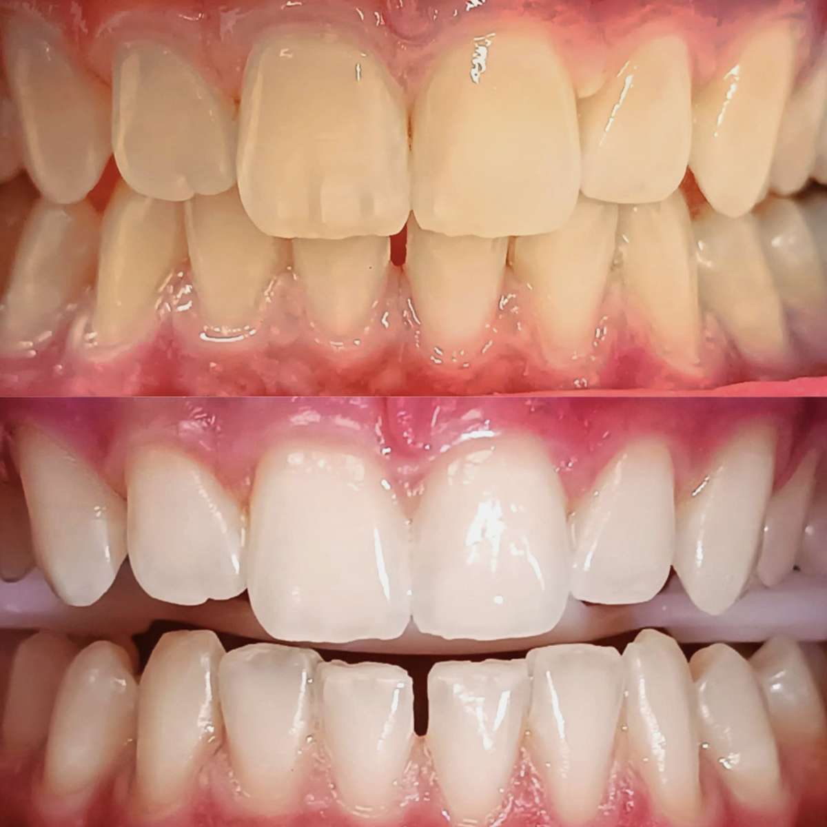 antes y después blanqueamiento dental led profesional en mejor clínica estética dental Madrid. Dientes más blancos en clínica Calvo de Mora