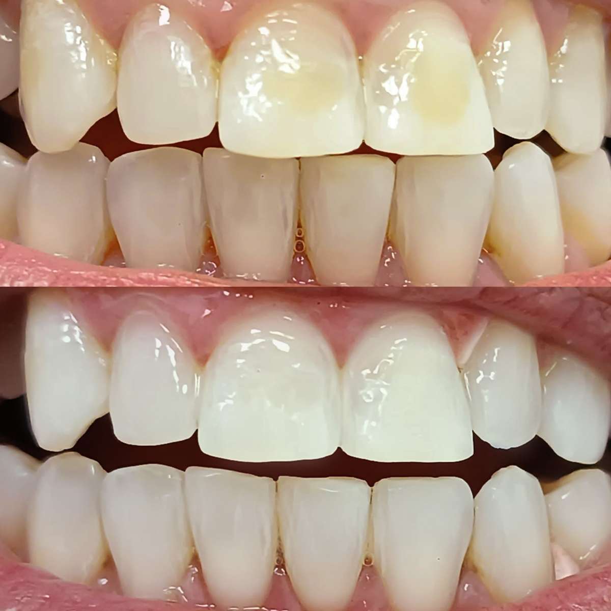 antes y después blanqueamiento dental led profesional en mejor clínica estética dental Madrid. Dientes más blancos en clínica maxilofacial