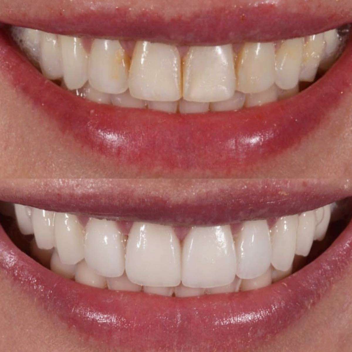 antes y después blanqueamiento dental led profesional en mejor clínica dental estética Goya. Dientes más blancos en clínica Calvo de Mora