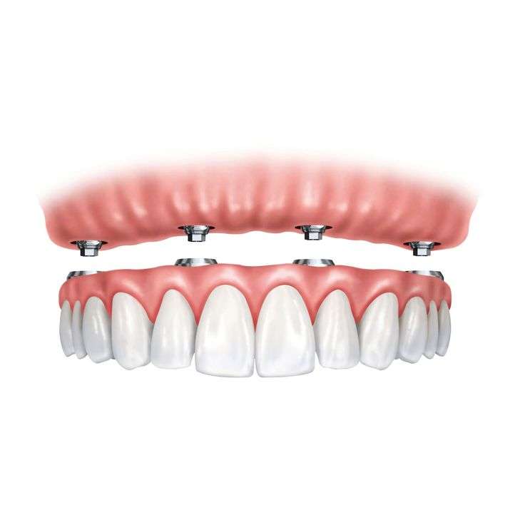 clínica maxilofacial Calvo de Mora Madrid dentista, rehabilitación oral, arreglar boca, prótesis sobre implantes dentales, centro dental