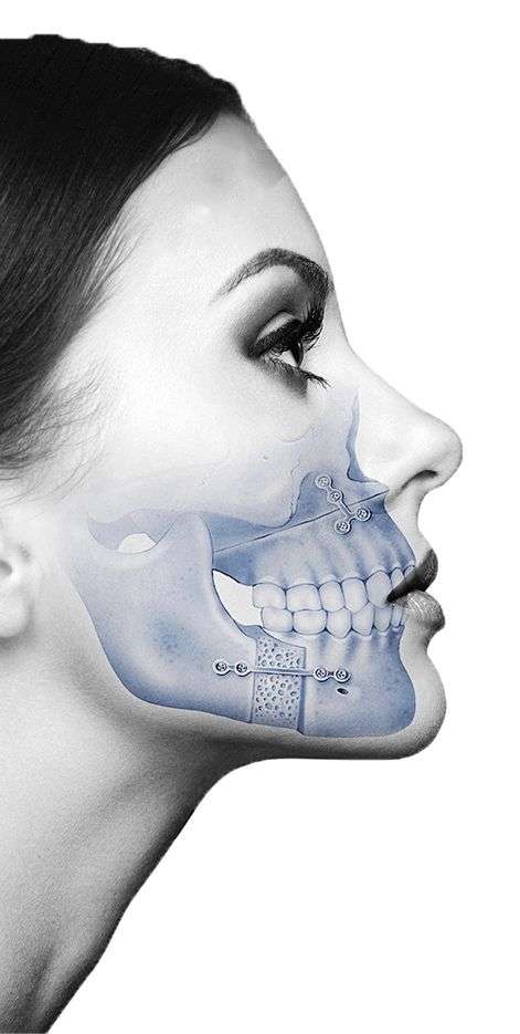 Clínica maxilofacial, mejor edad para la cirugía ortognática, mentoplastia, mordida abierta, prognatismo, clínica dental Madrid
