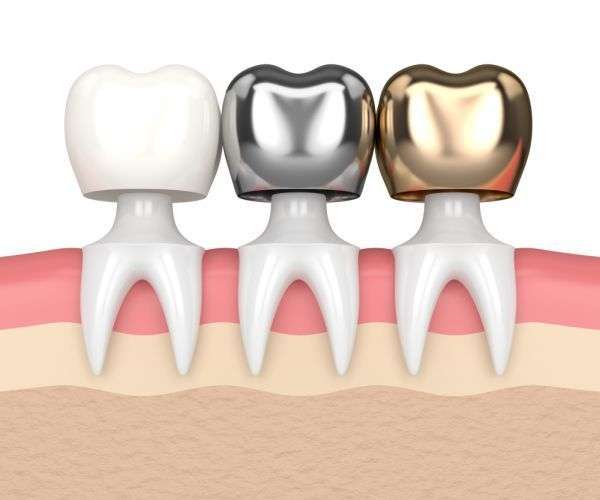 Clínica maxilofacial Calvo de Mora Madrid, dentista, coronas dentales rehabilitación oral