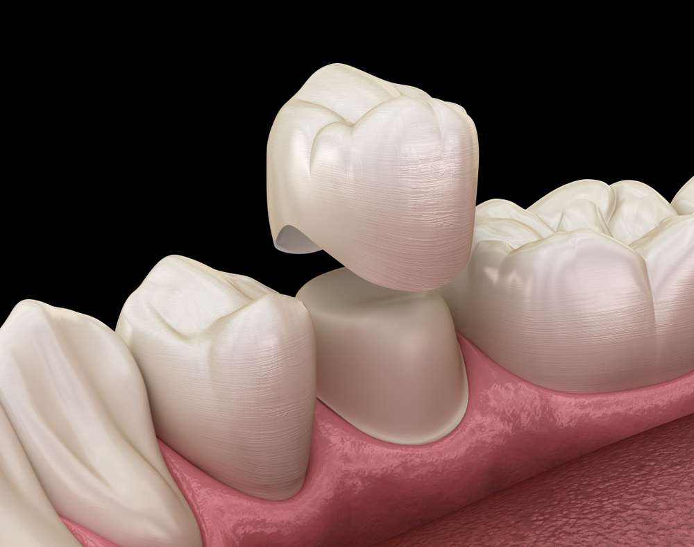clínica Madrid, Calvo de Mora, coronas dentales, fundas dentales, coronas de porcelana, metal-porcelana, fundas dentales de porcelana