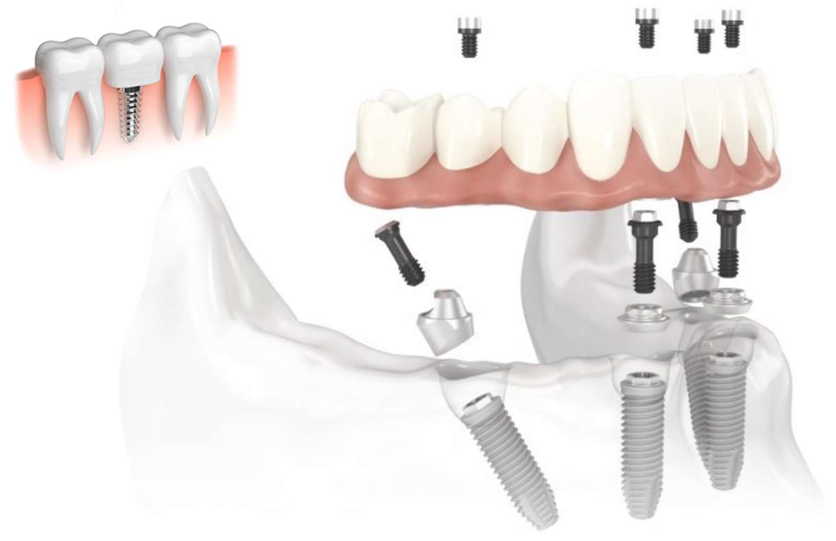 Qué son los implantes de carga inmediata. Clínica dental en madrid, dentistas odontólogos de clínica calvo de mora