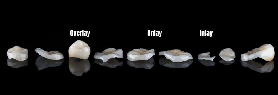 incrustaciones dentales, Clínica calvo de Mora Madrid, incrustaciones porcelana, tipos incrustaciones, precio incrustaciones clínica dental