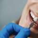 blanqueamiento antes de colocar carillas dentales en clínica estética dental madrid. Odontólogos para carillas dentales, diseño de sonrisa
