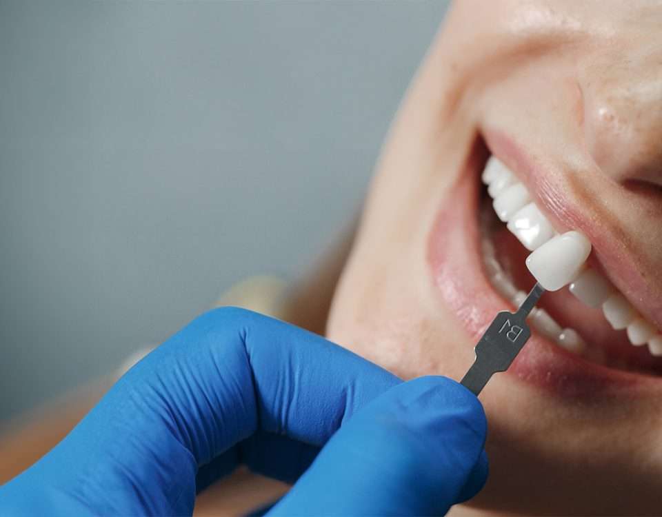 blanqueamiento antes de colocar carillas dentales en clínica estética dental madrid. Odontólogos para carillas dentales, diseño de sonrisa