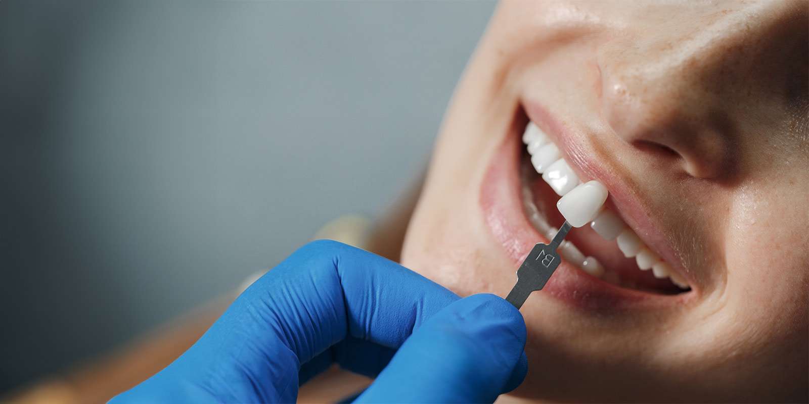 blanqueamiento antes de colocar carillas dentales en clínica estética dental madrid. Odontólogos para carillas dentales, diseño de sonrisa