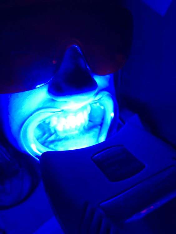 realizar blanqueamiento dental led en clínica dental calvo de mora. odontologos madrid colocar carillas dentales, diseño de sonrisa, peróxido de hidrógeno