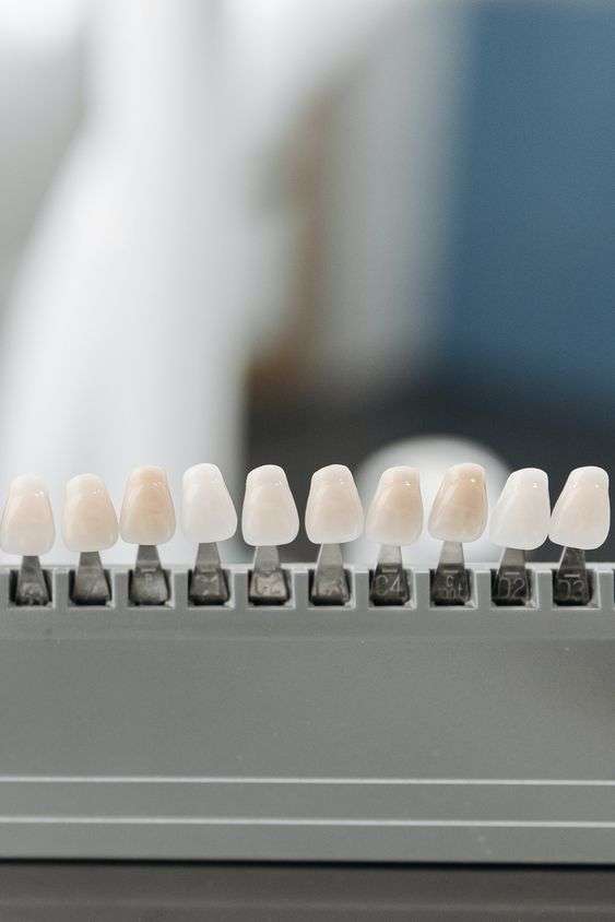 carillas dentales Madrid, diseño de sonrisa clínica dental calvo de mora, carillas composite vs porcelana, eliminar manchas en los dientes