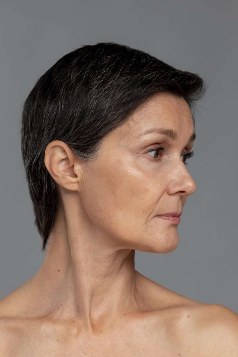 clínica Clavo de Mora Madrid medicina estética patas de gallo con botox toxina botulínica