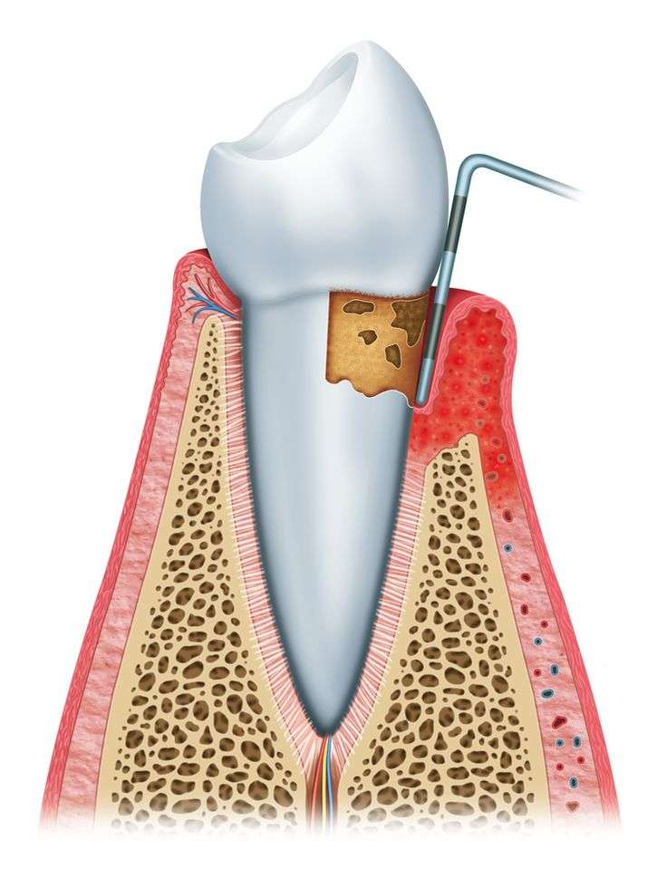 clínica maxilofacial Calvo de Mora Madrid, enfermedades bucodentales, top 10 enfermedades dentales, periodontitis, dentista Madrid, especialista