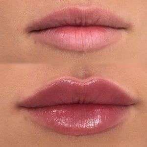 ácido hialurónico labios, aumento de labios, clínica maxilofacial Calvo de Mora Madrid, tratamientos ácido hialurónicos, técnica labios rusos