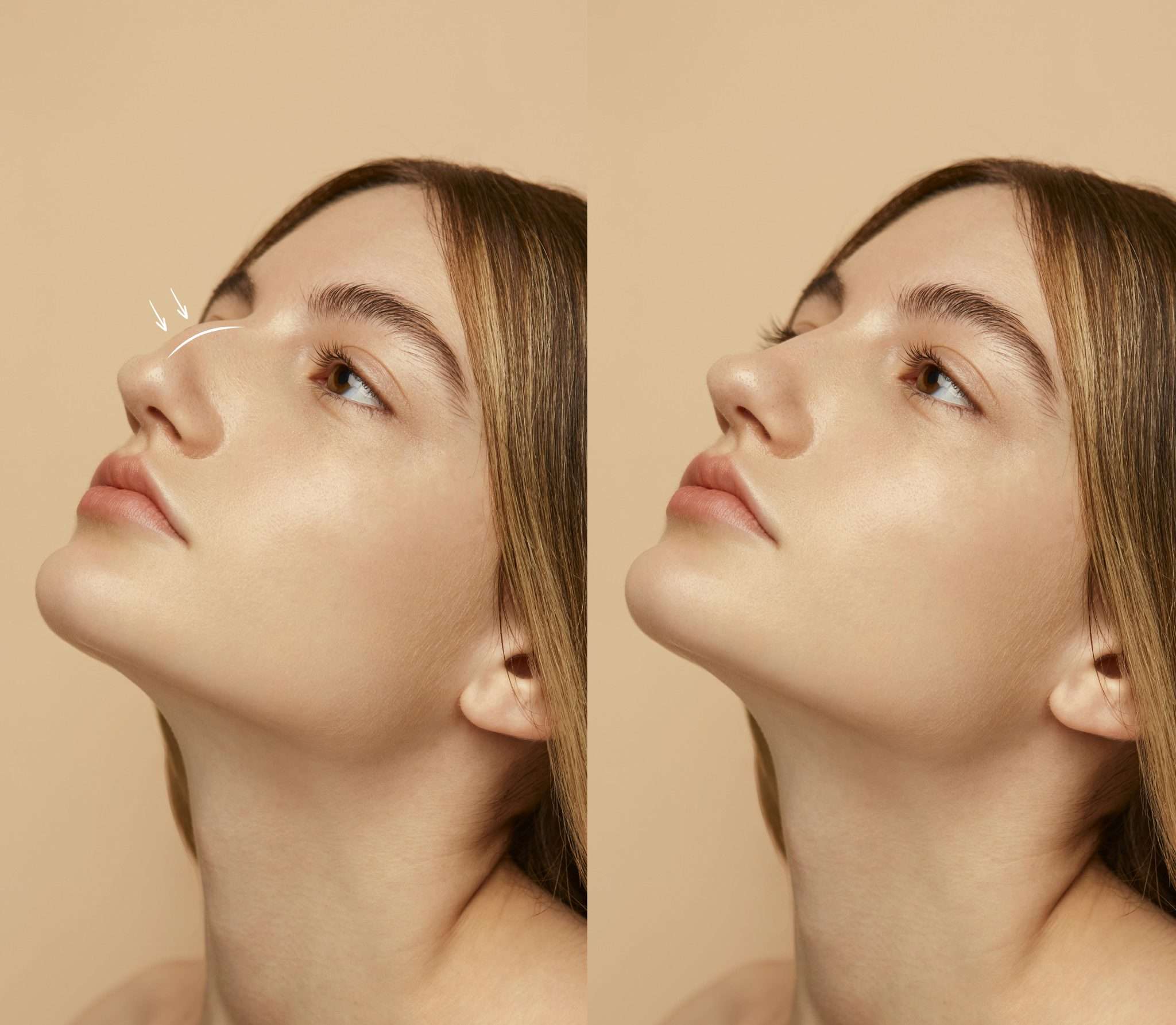 clínica maxilofacial Calvo de Mora Madrid, clínica estética especialistas ácido hialurónico nariz Madrid, remodelación de nariz sin cirugía
