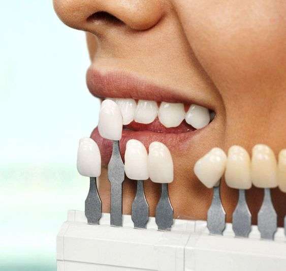 colocar carillas dentales odontólogos profesionales en clínica dental de Madrid calvo de mora. blanquear antes carillas de porcelana