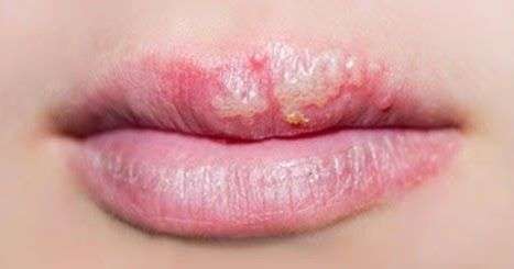 clínica maxilofacial Calvo de Mora Madrid, enfermedades bucodentales, top 10 enfermedades dentales, herpes labial, dentista Madrid, especialista