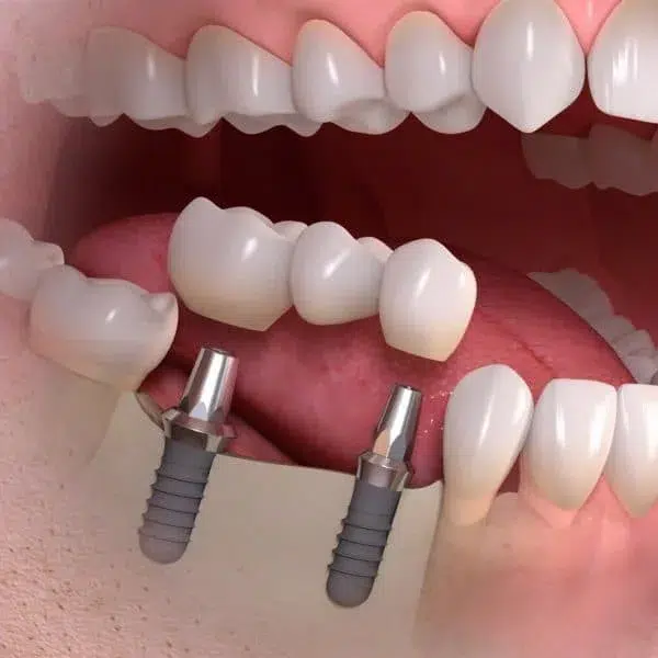 Implantes de carga inmediata en clínica maxilofacial en Madrid calvo de mora. Prótesis fija atornillada. Implantes Dentales