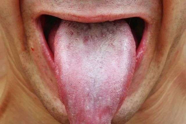 clínica maxilofacial Calvo de Mora Madrid, enfermedades bucodentales, top 10 enfermedades dentales, leucoplasia, dentista Madrid, especialista