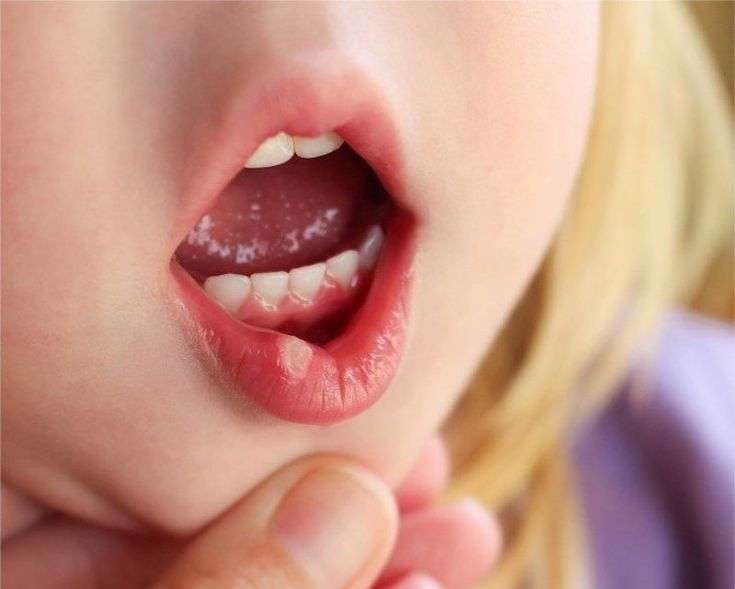 clínica maxilofacial Calvo de Mora Madrid, enfermedades bucodentales, top 10 enfermedades dentales, úlcera bucal, dentista Madrid, especialista
