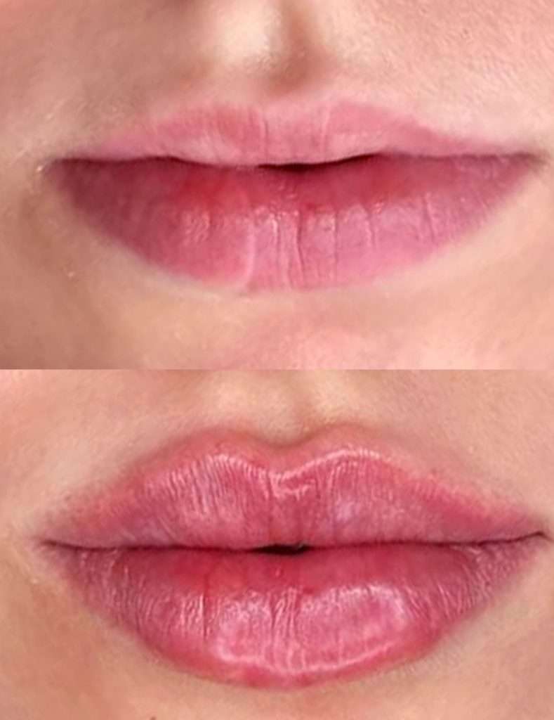 antes y después aumento acido hialurónico labios, clínica Madrid, precio aumento de labios, hidratación vs aumento, russian lips, labios rusos