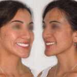 Antes y después cirugía ortognática, prognatismo mandibular clase 3, clínica maxilofacial especializada Madrid, Dr. Calvo de Mora