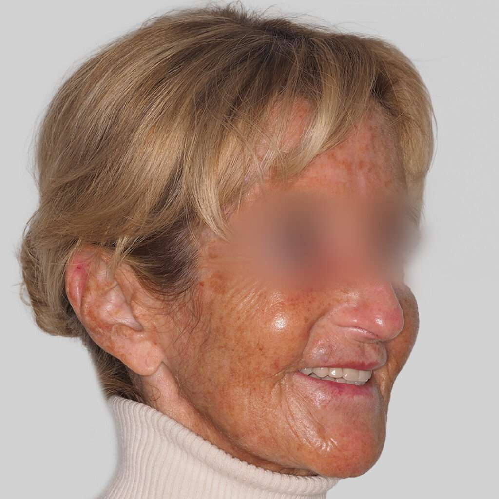 resultado después cirugía implantes corticales, mejores implantes dentales Madrid, clínica maxilofacial calvo de mora. Caso real implantología