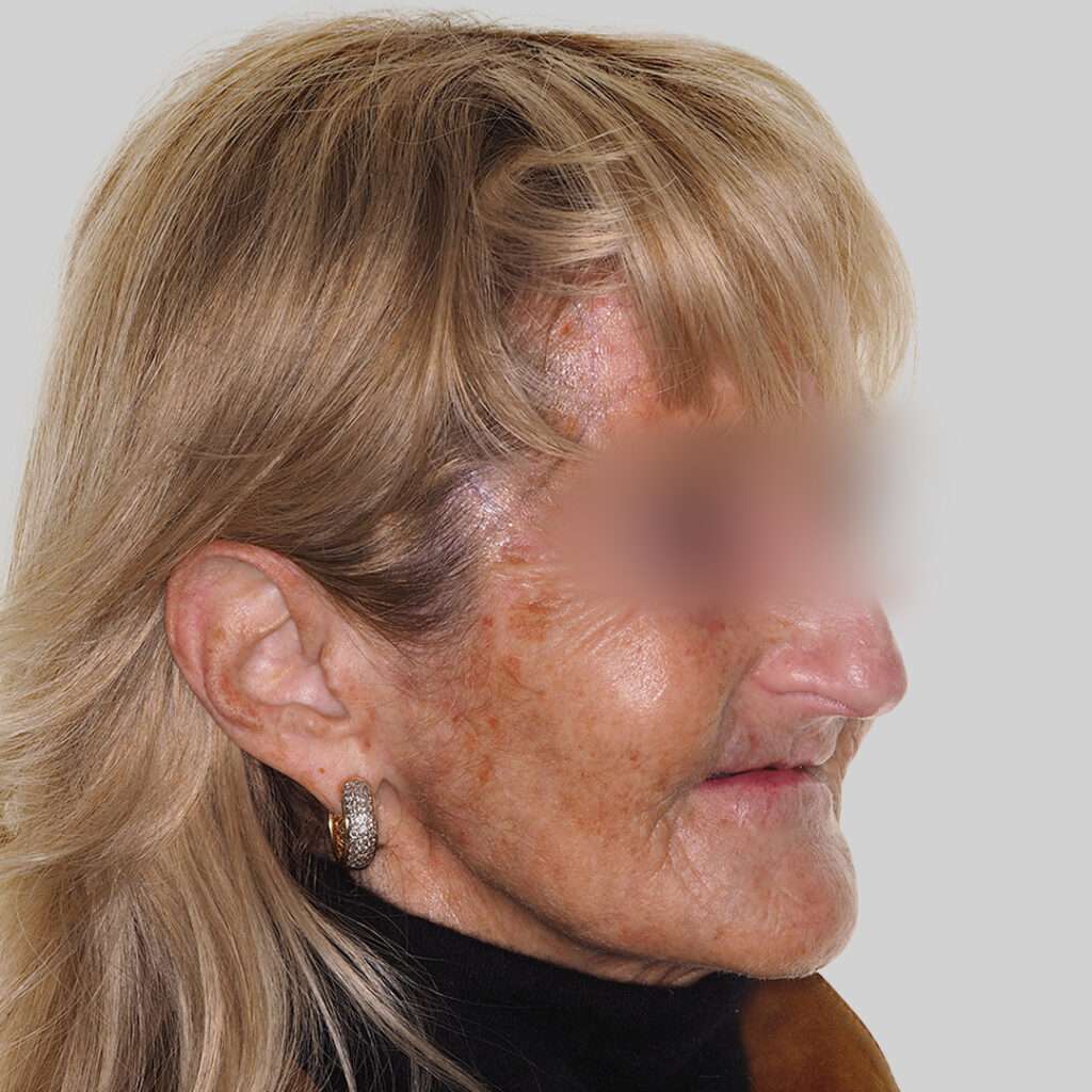 antes y después cirugía de implantes corticales, mejores implantes dentales Madrid, en clínica maxilofacial calvo de mora. Caso real implantología