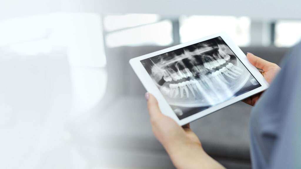 Clínica Maxilofacial Madrid, Radiografía y Diagnóstico en implantes dentales, mejor cirugía implantes corticales, dientes fijos en 24h