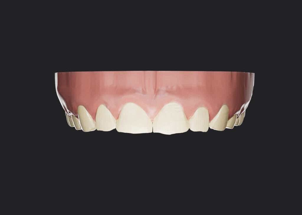 procedimiento en clínica dental para la colocación de carillas estéticas guiadas. Toma de medidas FirstFit