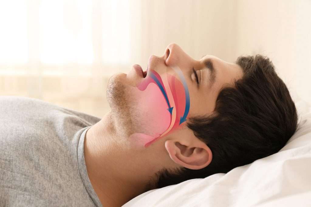 precio dispositivo de Avance Mandibular (DAM), Apnea del Sueño AOS, Tratamiento definitivo para la apnea del sueño, sueño reparador, ronquidos