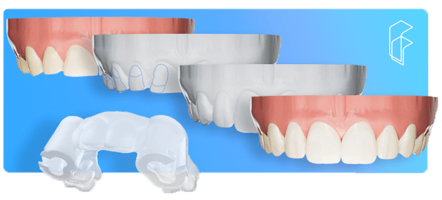 proceso de colocación carillas dentales tecnología FirstFit, Carillas estéticas guiadas, clínica dental, mockup simulación diseño de sonrisa