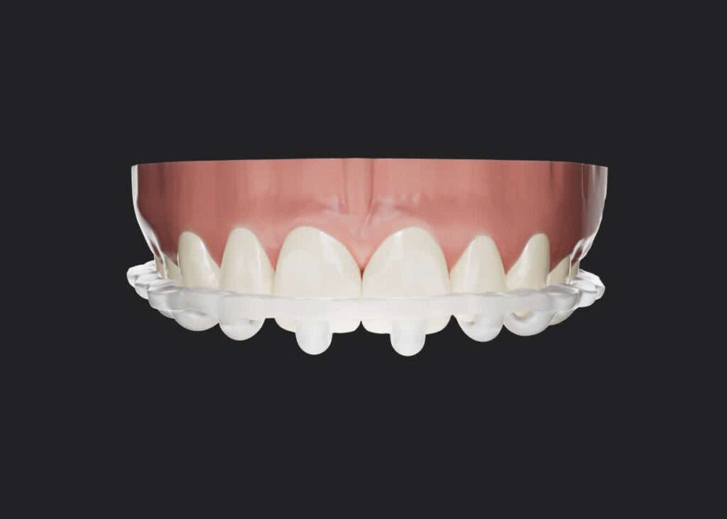 Probar carillas estéticas guiadas antes de comenzar tratamiento de diseño de sonrisa digital. Clínica dental madrid carillas dentales